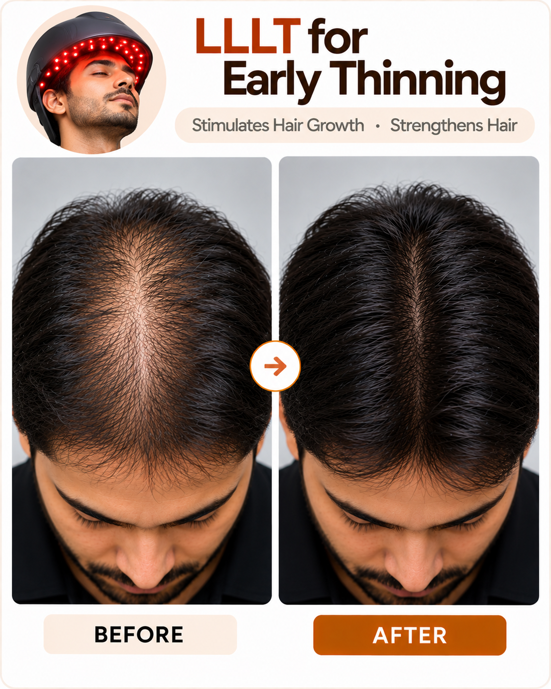 LLLT laser hair treatment for early hair thinning at Vridhi Skin Clinic, Sindhanur