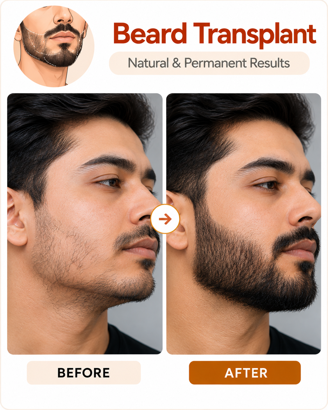 Beard transplant for patchy beard at Vridhi Skin Clinic, Sindhanur