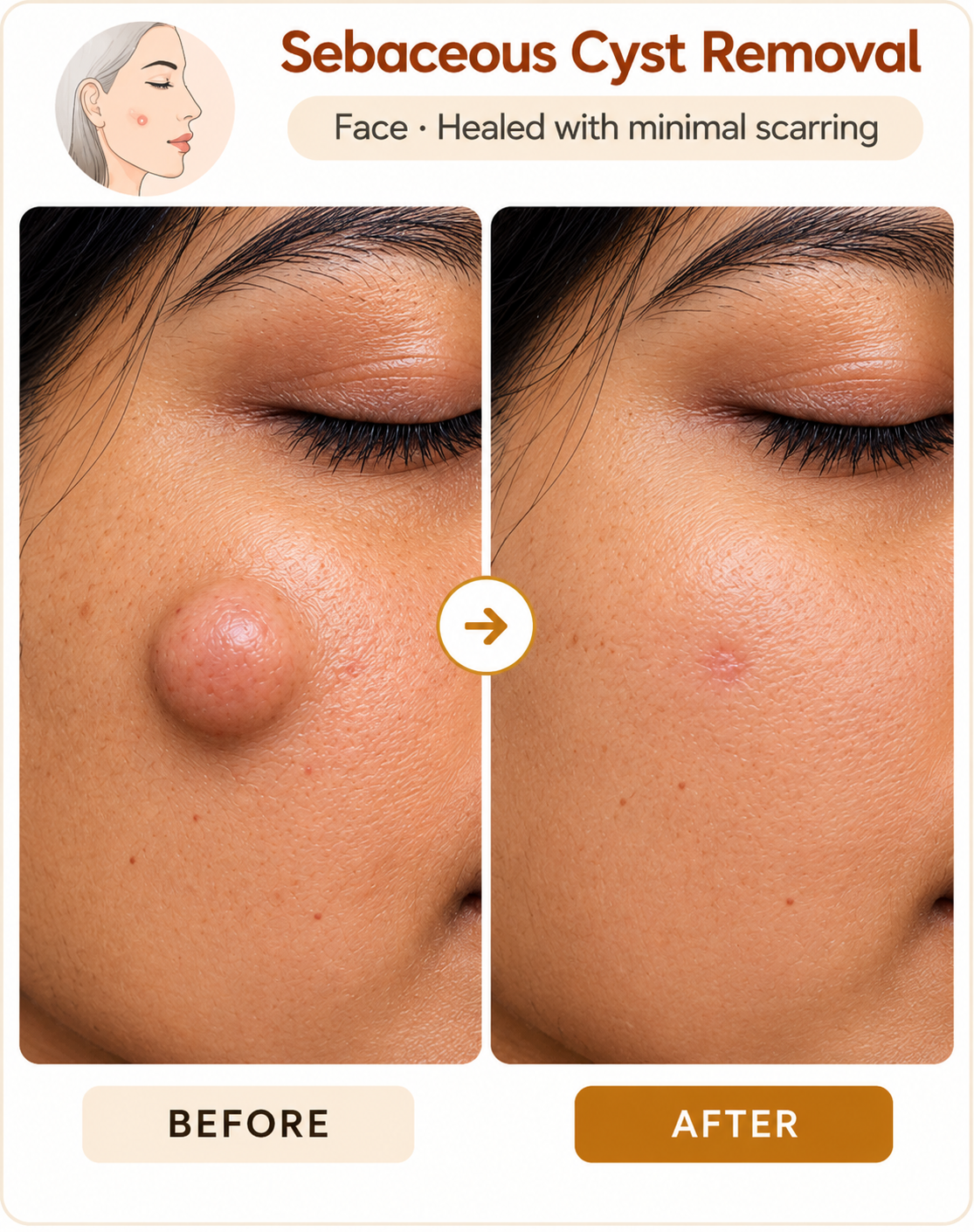 Sebaceous Cyst Removal at Vridhi Skin Clinic, Sindhanur