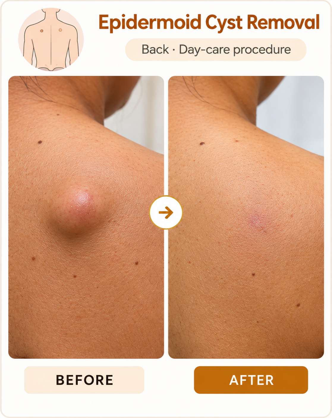 Epidermoid Cyst Removal at Vridhi Skin Clinic, Sindhanur