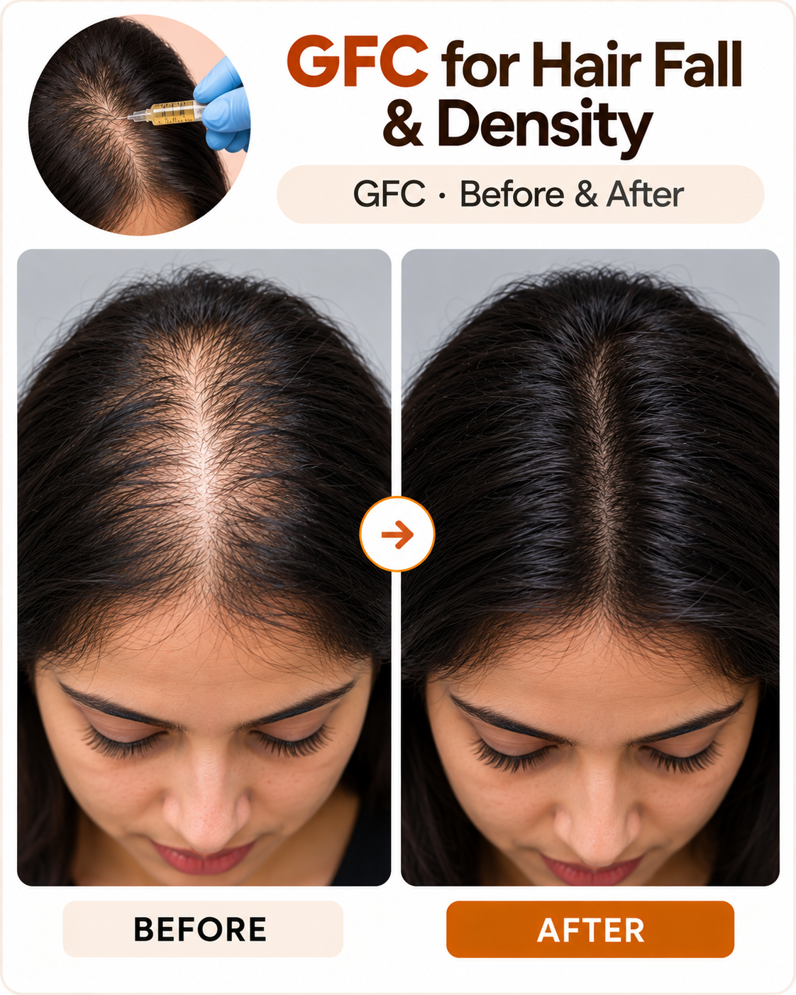 GFC hair treatment for hair fall and low density at Vridhi Skin Clinic, Sindhanur