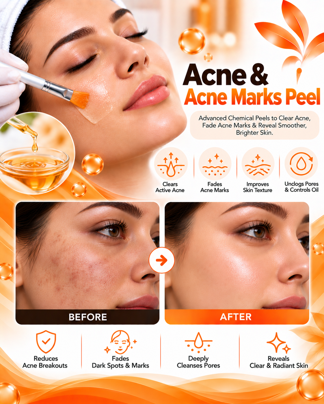 Chemical peel for acne and acne marks before and after at Vridhi Skin Clinic, Sindhanur